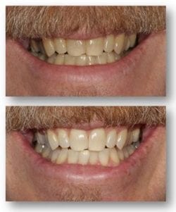 Pamela Doray Deep teeth bleaching results