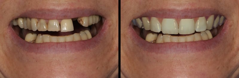 Cosmetic Dentistry Before & After