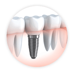 dental implants in Philadelphia PA with Pamela Doray DMD