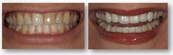 before and after dental crowns treatment in Philadelphia