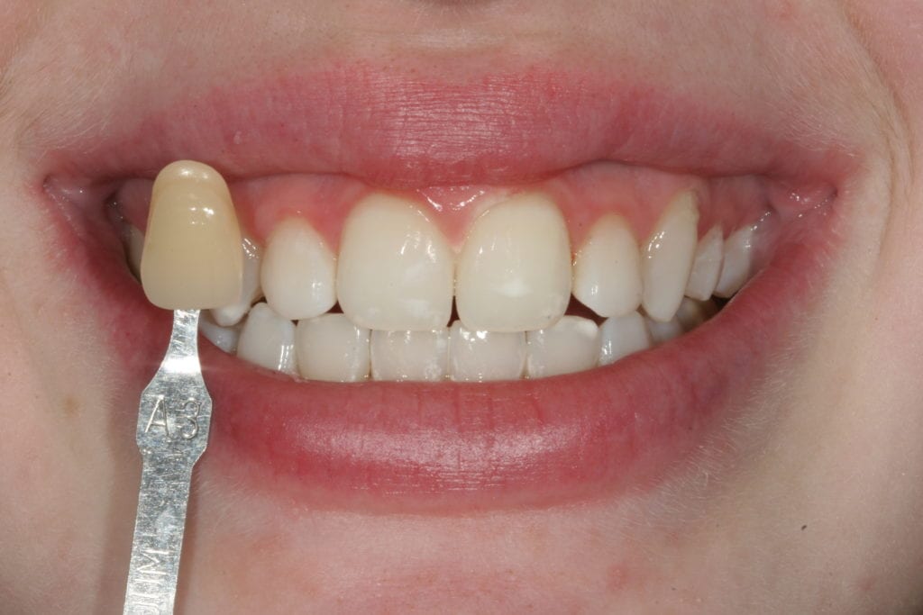 Secondary Gallery Image  | Whitening Case