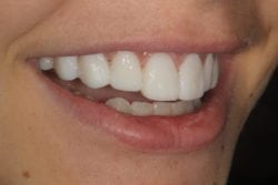 cosmetic dentistry temporary restorations