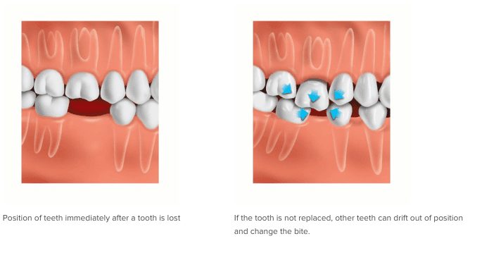 Teeth alignment shift because of missing teeth example