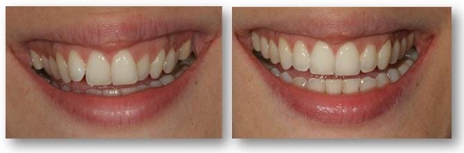 Amaya before and after Invisalign treatment in Philadelphia