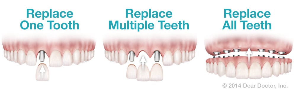 dental implant replacement options