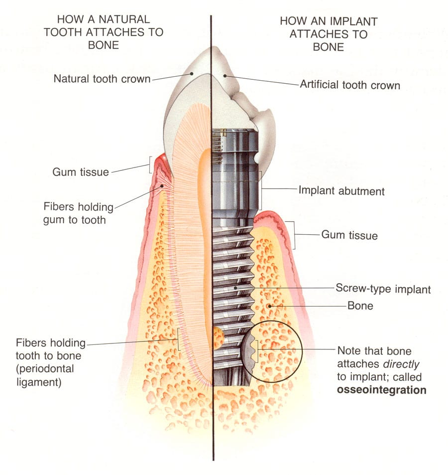 how a dental implant attaches to bone infographic
