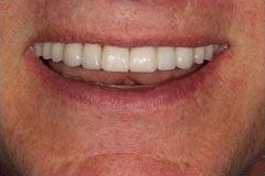 Kent Dental Implants after visiting cosmetic dentist Dr. Pamela Doray