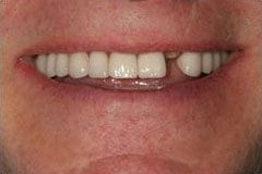 Kent Dental Implants before visiting cosmetic dentist Dr. Pamela Doray