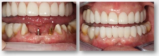 before and after implant supported dental bridge