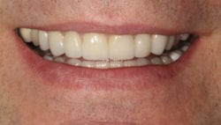 After teeth grinding treatment in Philadelphia PA