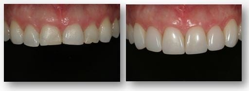 Maria results after tooth bonding in Philadelphia PA
