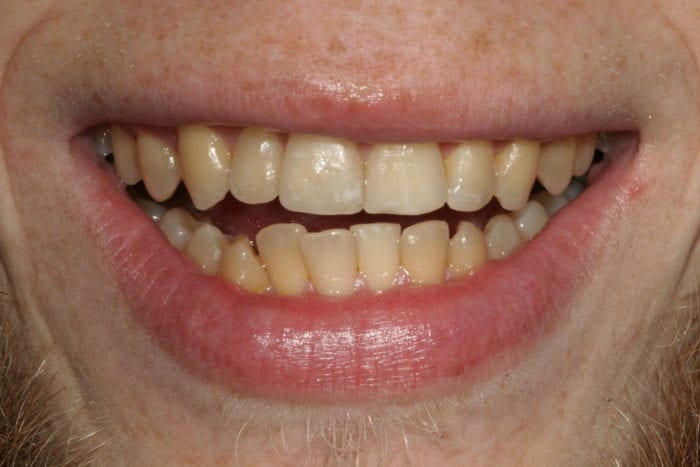 tooth bonding for chipped tooth by Philadelphia dentist Pamela Doray