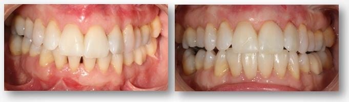 Sandy J before and after dental bonding