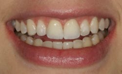 Ava after porcelain veneers for chipped teeth in Philadelphia PA