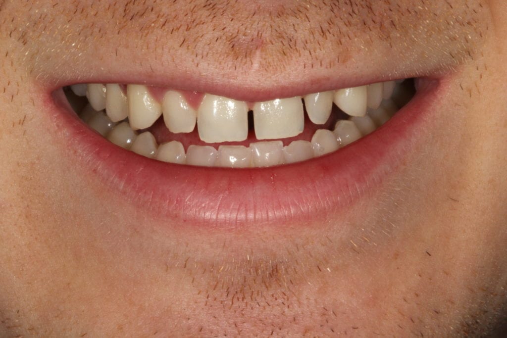 Main Gallery Image  | Diastema – Used Dental Bonding