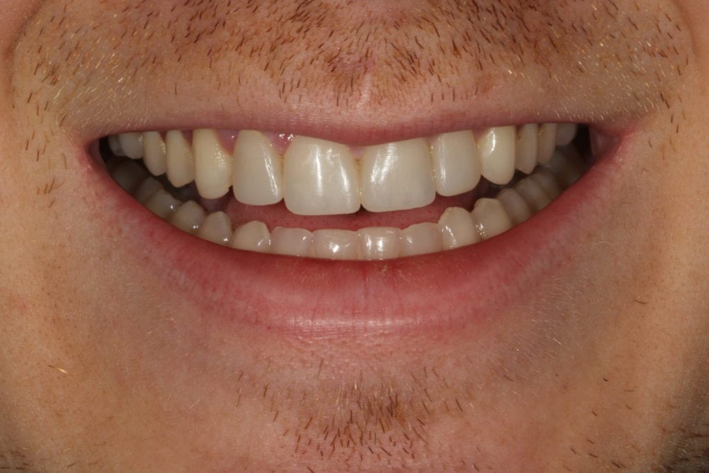 Secondary Gallery Image  | Diastema – Used Dental Bonding