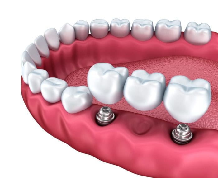 multiple dental implants in Philadelphia Pennsylvania