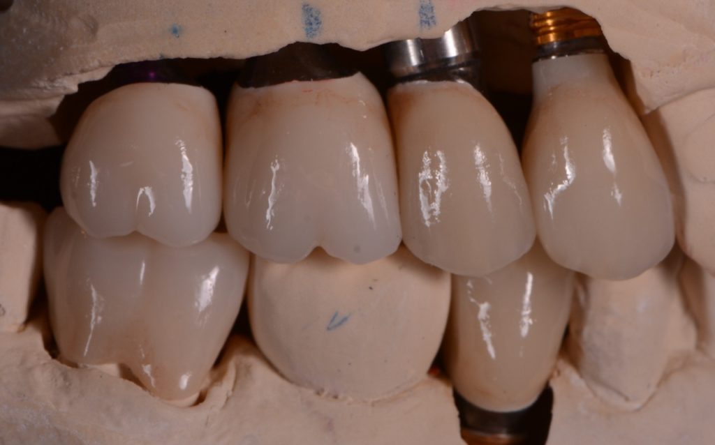 Restore Missing Teeth in Philadelphia, Pennsylvania
